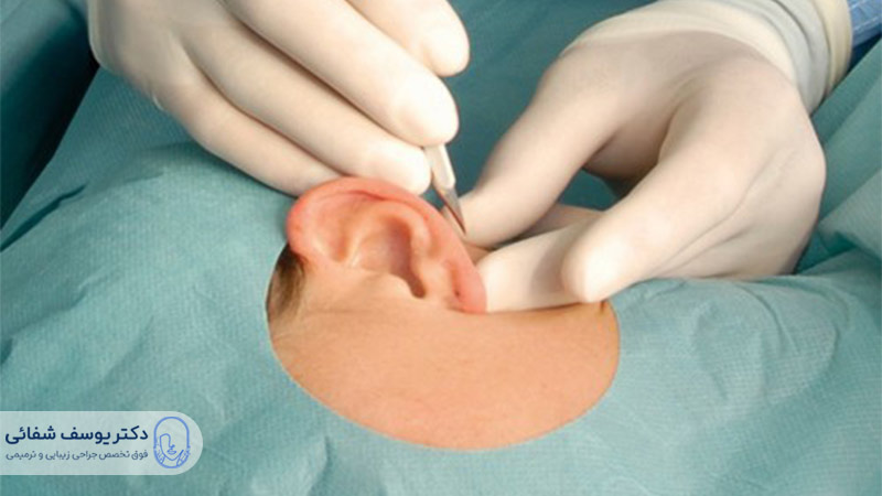 جراحی زیبایی گوش چگونه انجام میشود؟